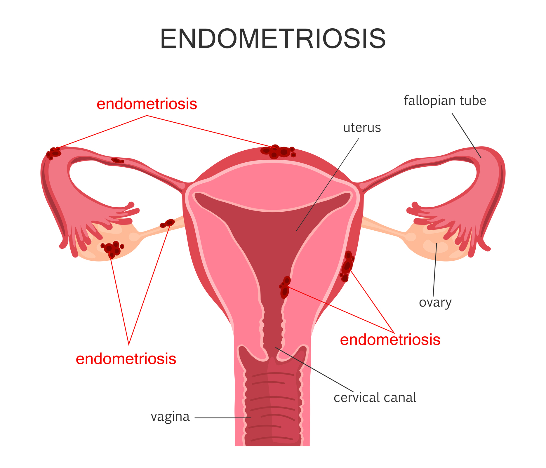 Endometriose e menstruação