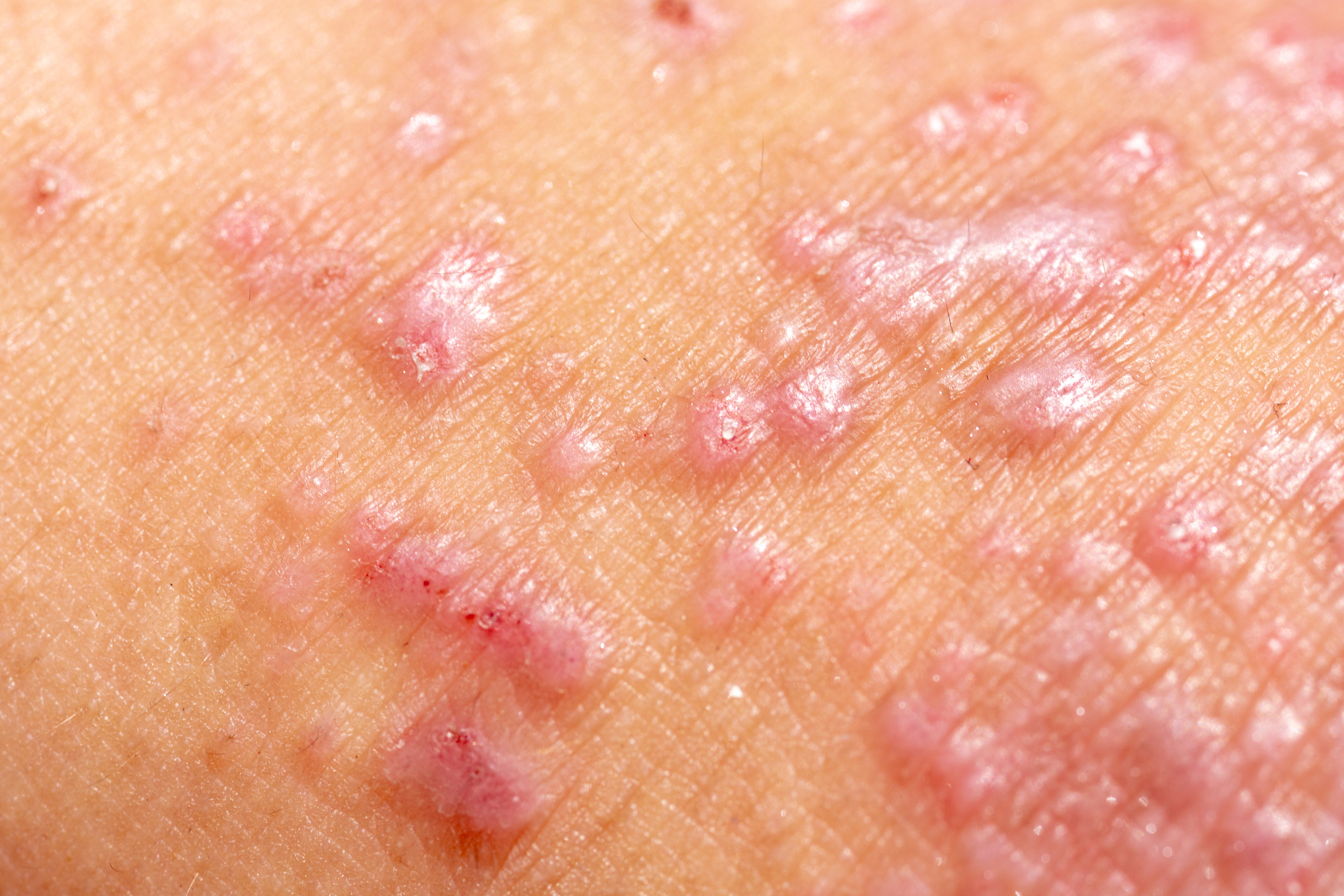Imagem mostra uma pele empolada por causa de uma doença 
